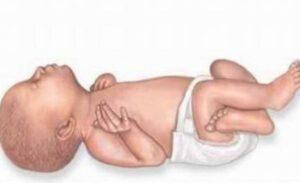 Ohtahara Sendromu Kaç Yaşına Kadar Yaşar?