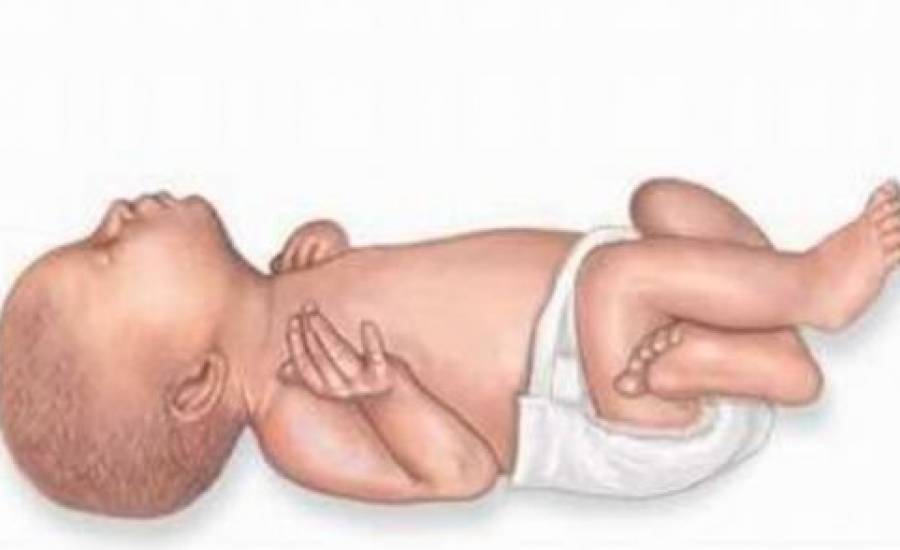 Ohtahara Sendromu Kaç Yaşına Kadar Yaşar?